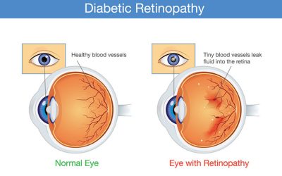 15 Facts About Diabetic Retinopathy